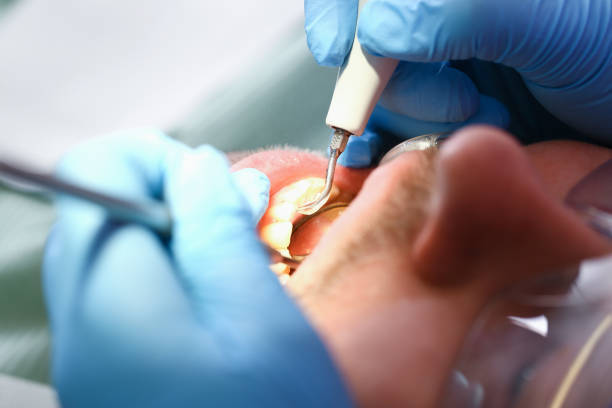 Best Emergency Dental Extractions in Farngton Hills, MI