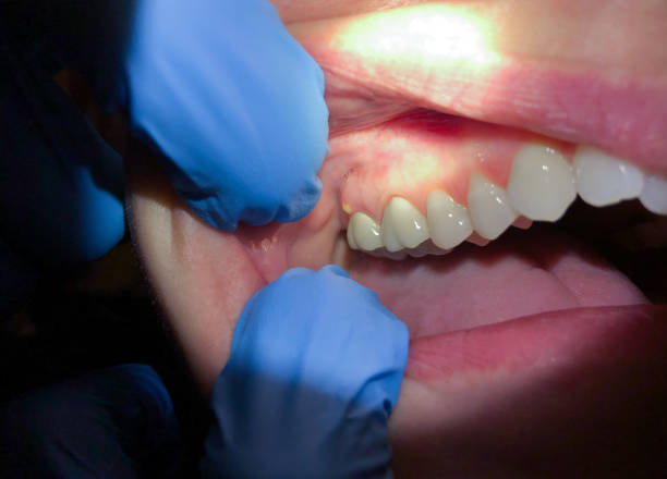 Best Emergency Root Canal Treatment in Farngton Hills, MI
